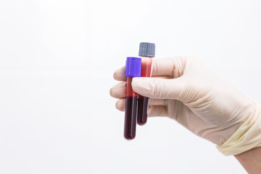 hand-holding-blood-tests-tubes-1-min-1